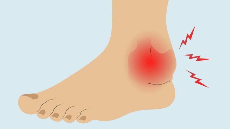 Arthrosis of the lower ankle joint